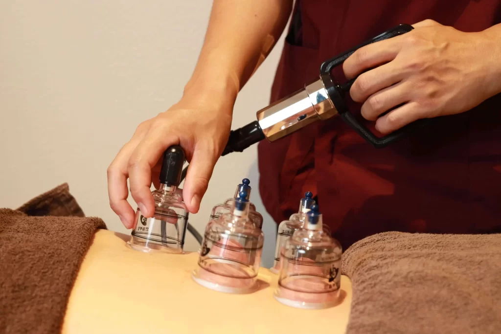 痛みに対しての吸い玉・カッピング